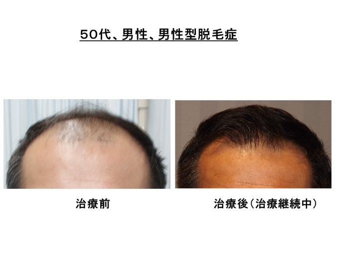 円形脱毛症　病院